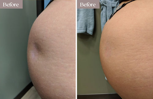 renuva butt before after nyc